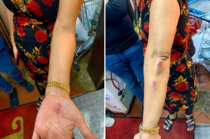 Mrs Hindocha Nitu Vishnubhai shows her injuries sustained from getting assaulted. 